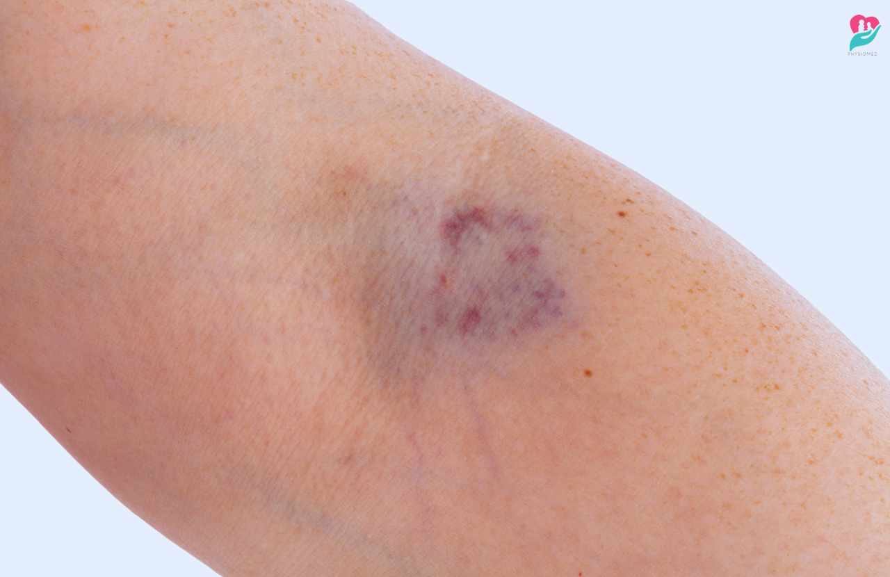 how to get rid of bruises from donating plasma
