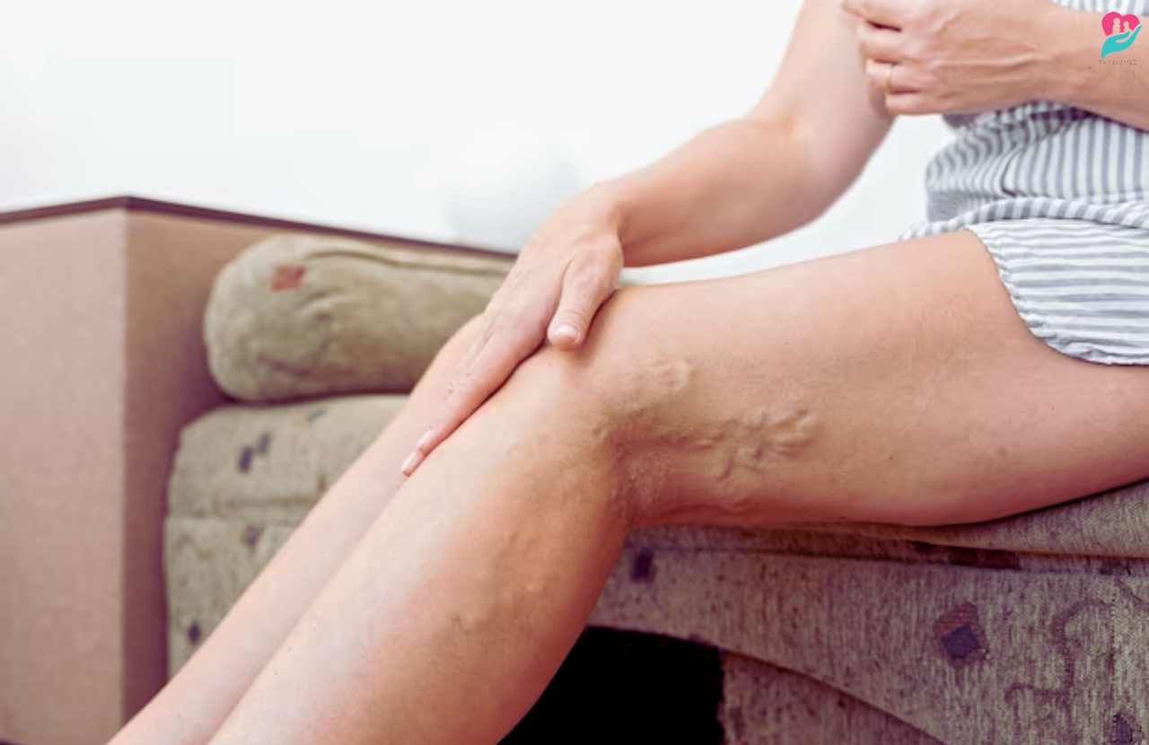 why can't you massage varicose veins
